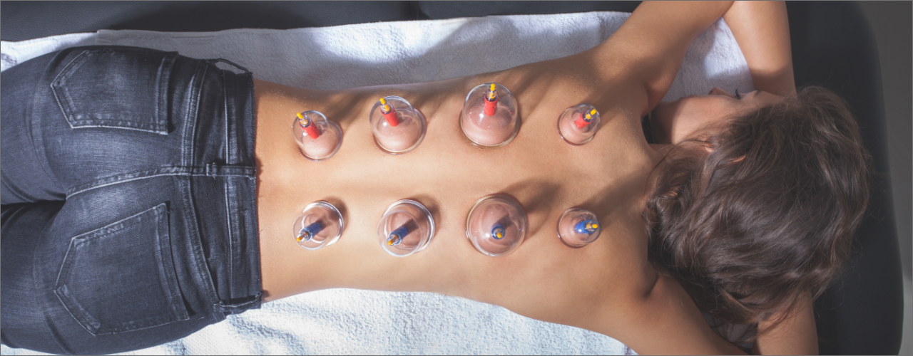 cupping-Precision-Physical-Therapy-Sandy-UT